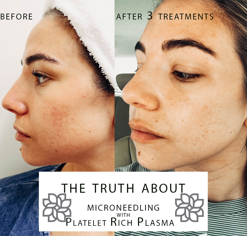 A review of microneedling treatment (with before and after phohtos) by Lauryn Hock of the Utah beauty blog Lauryncakes.com