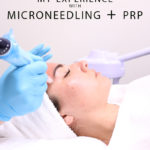 mirconeedling with PRP
