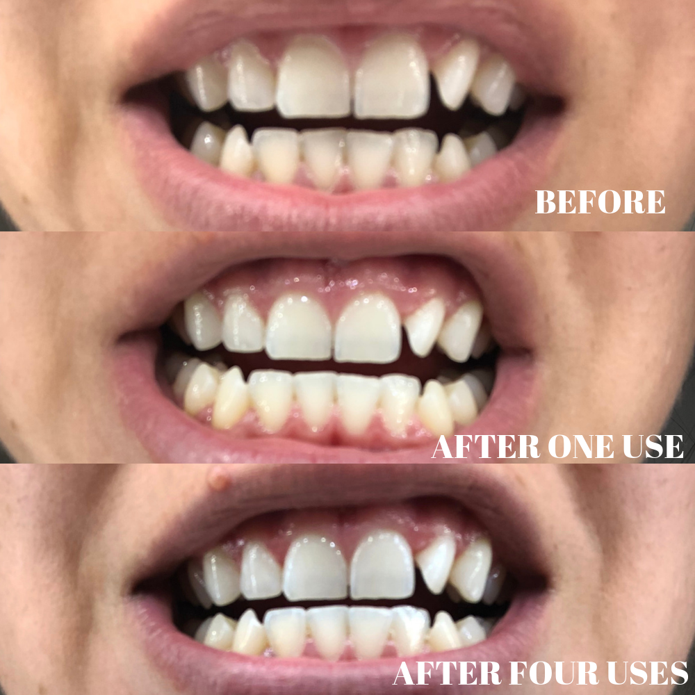 before and after photo using ARC Smile whitening strips for teeth