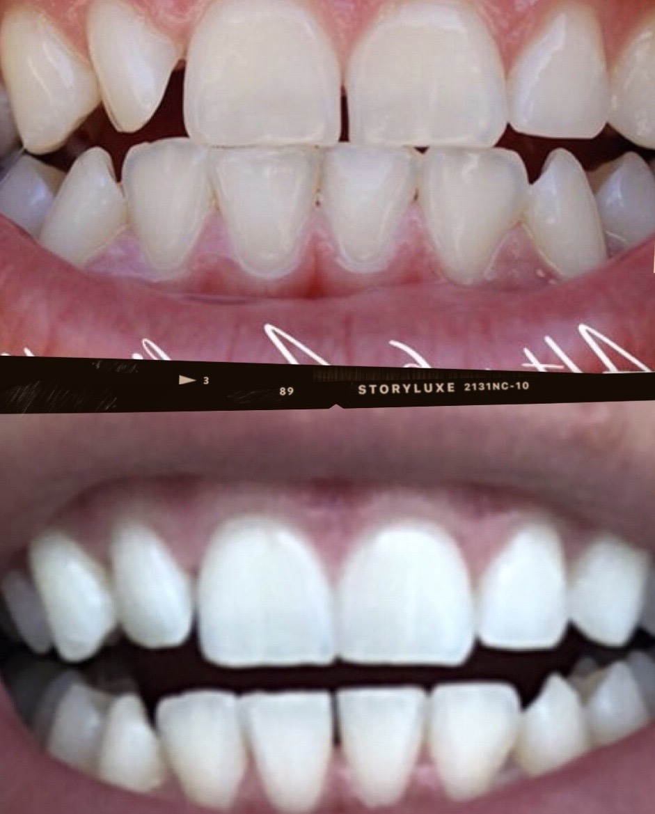 before (top) and after (bottom) photos after a year of using Smilelove Teeth Aligners. 