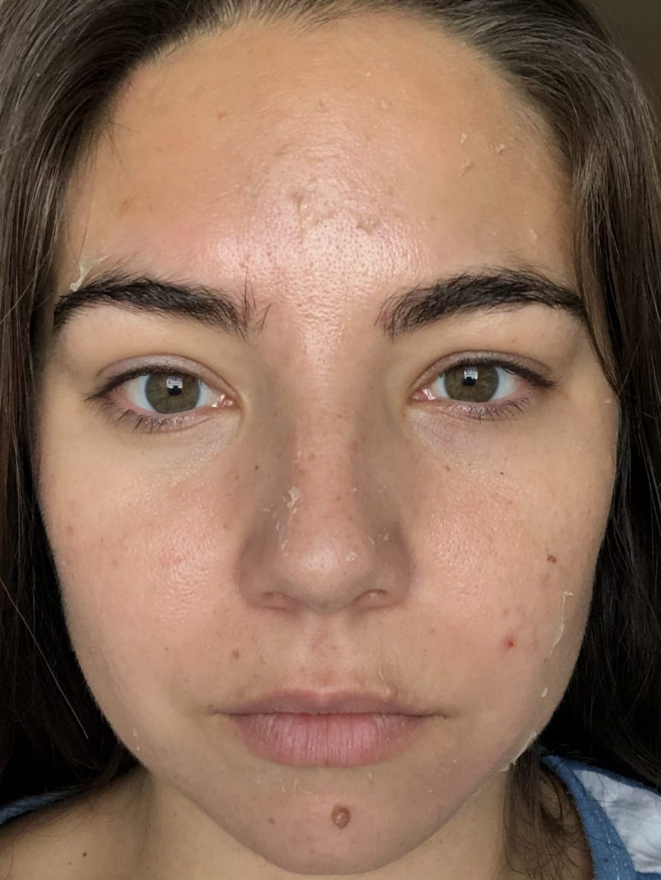 Jessner Chemical Peel Beforeafter Photos Of The Proven Facial Lauryncakes 0595