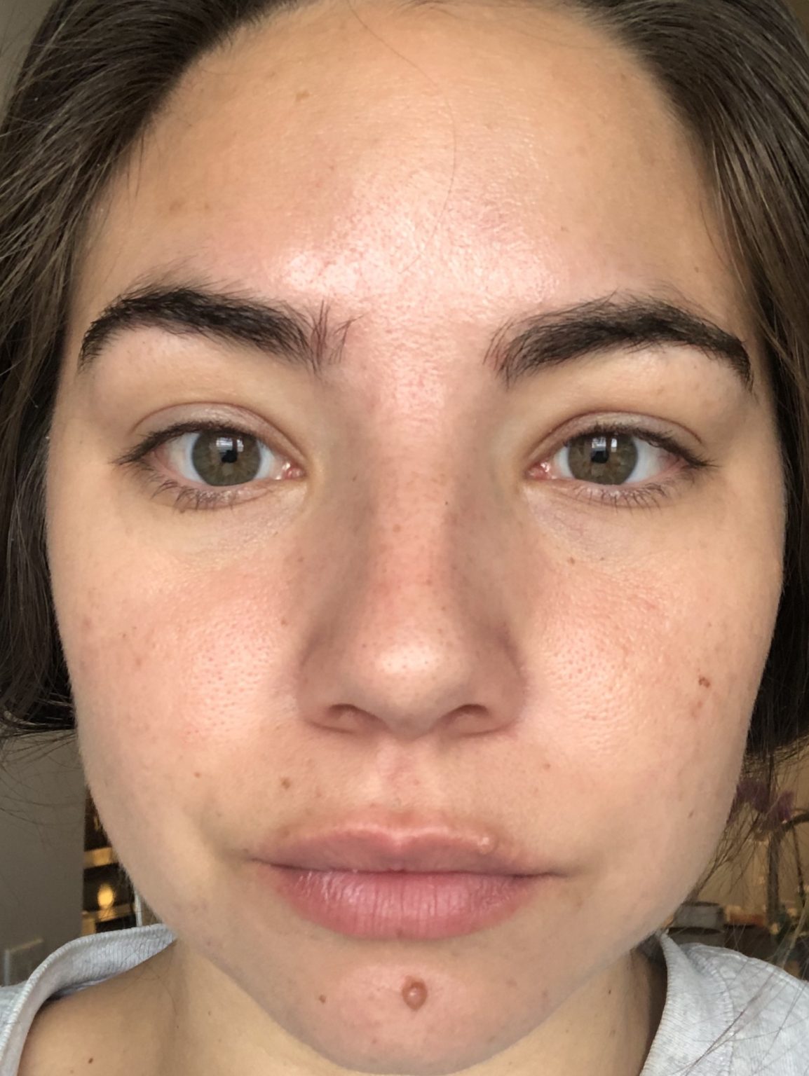 Jessner Chemical Peel Beforeafter Photos Of The Proven Facial Lauryncakes 