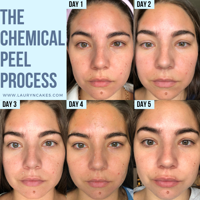 The peeling process (days 1-5) after getting a Jessner Chemical Peel