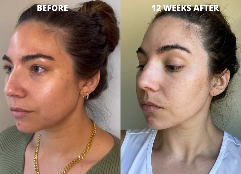 Cheek Fillers My Experience Getting Injections With Before After Photos Lauryncakes 