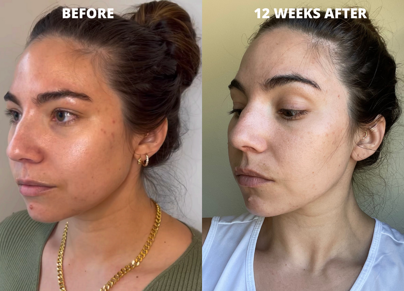 before and after results of cheek filler injections on a 30-year-old-waomn