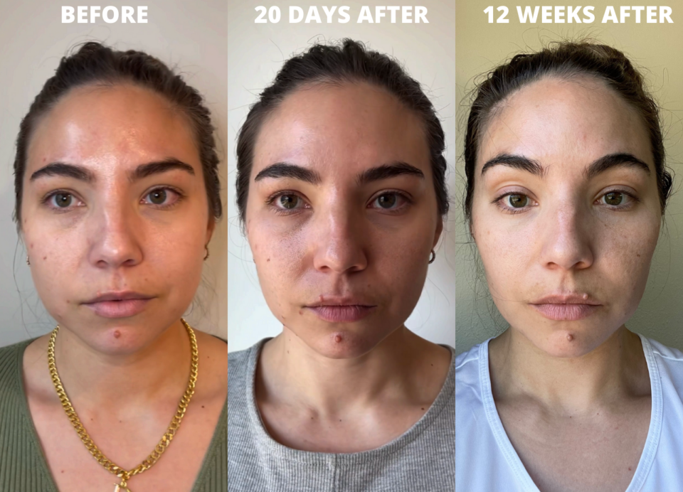 Cheek Fillers My Experience Getting Injections With Before After Photos Lauryncakes 