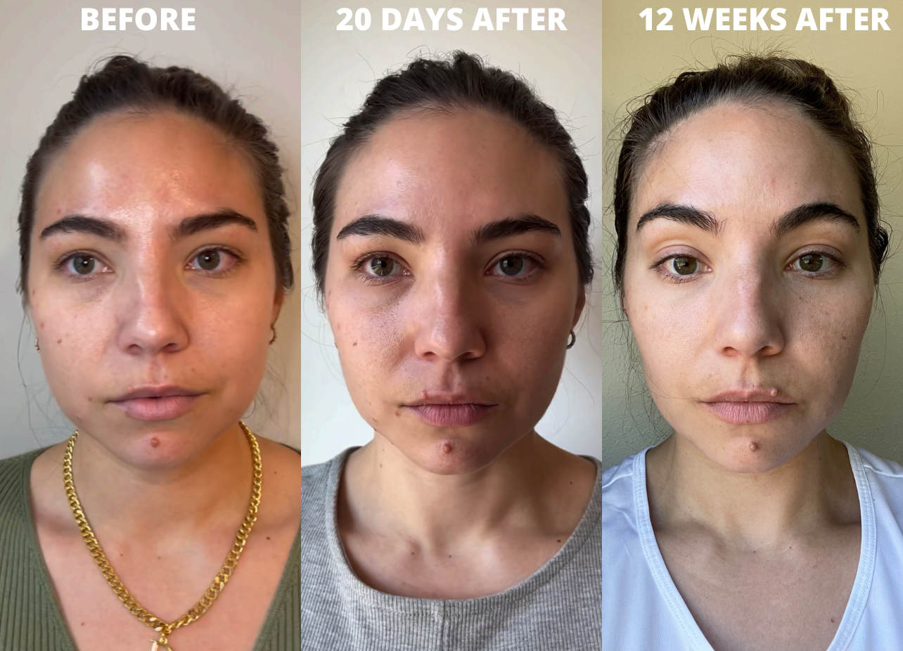 cheek fillers before and after photos at 20 days after, and 12 weeks after getting injections
