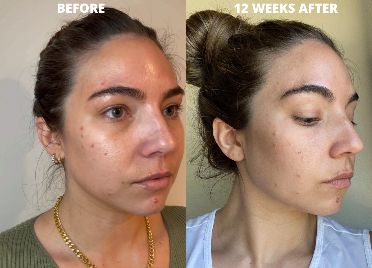 cheek injections of juvaderm filler on woman in her 30s.. Before and after result photos