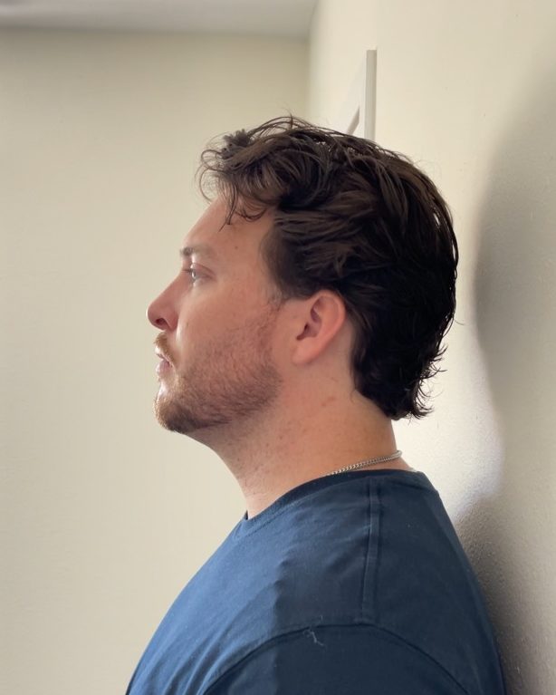 male patient, 2 weeks after Kybella injections, profile view
