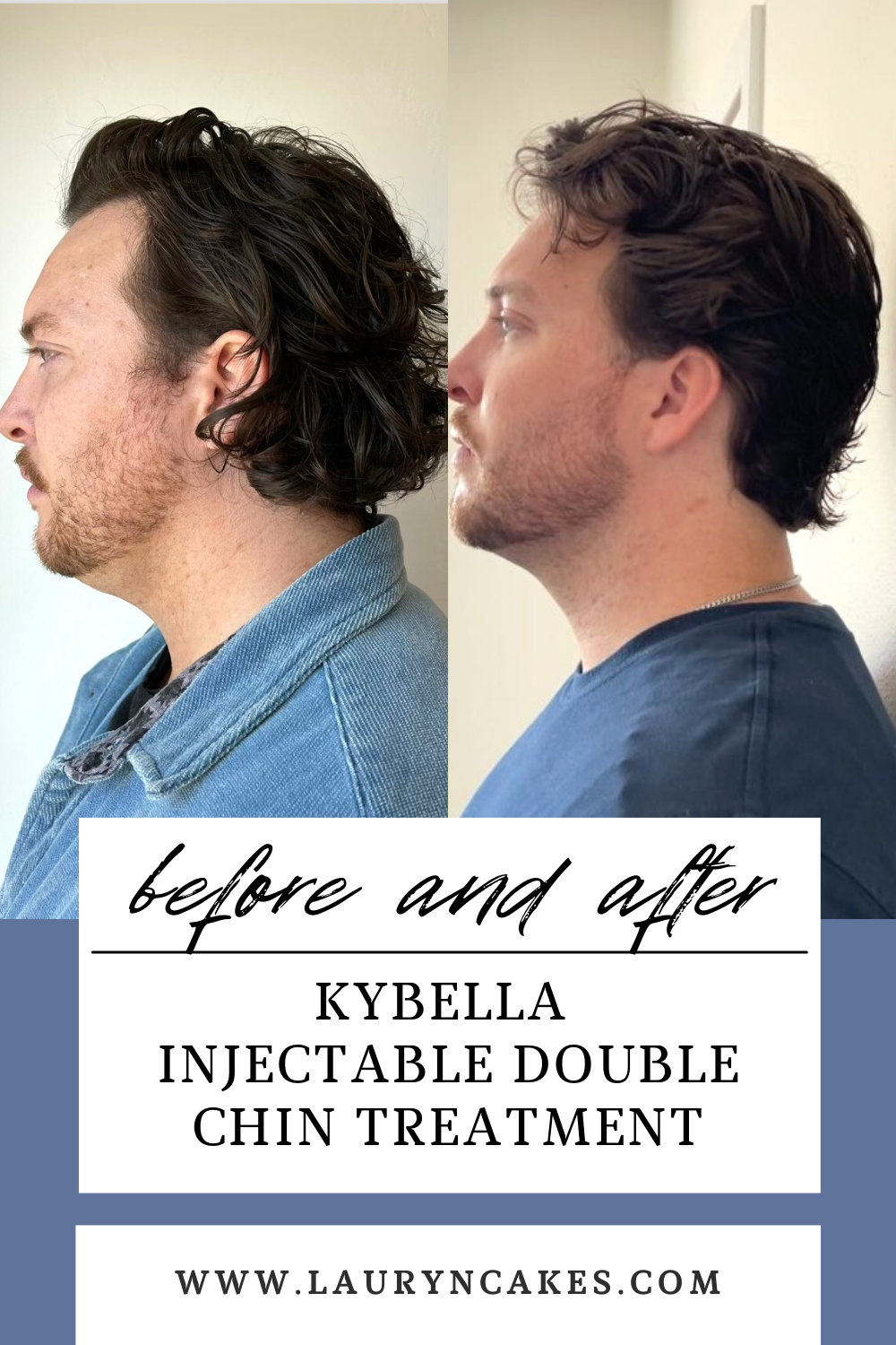 side by side before and after photo of kybella double chin treatment