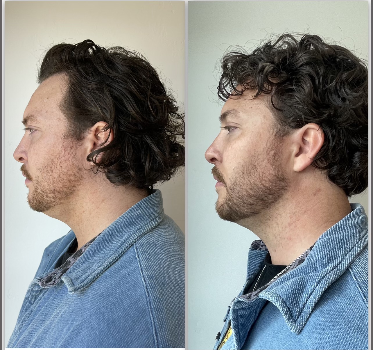 side by side comparison of before and after images of a male Kybella patient after 1 treatment.
